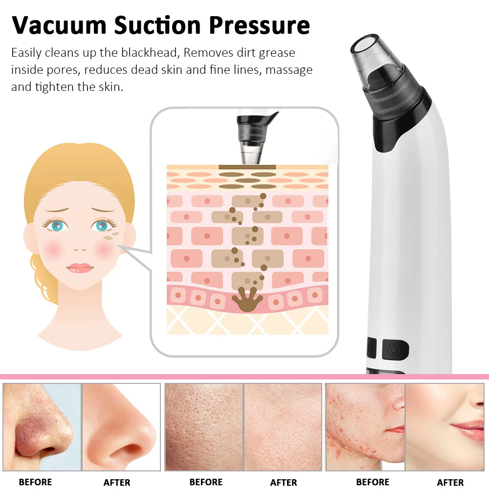 Blackhead Vacuume Remover
